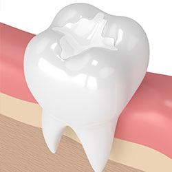 Fillings
